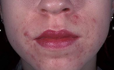 Пероральный дерматит на коже лица - фото