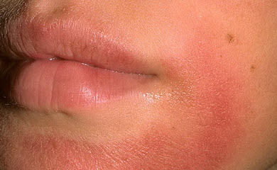 контактный и кожный дерматит на лице - фото