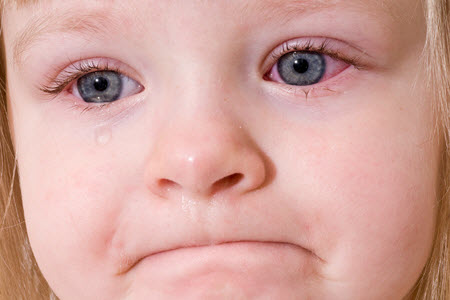 Покраснение белка глаза у ребенка фото