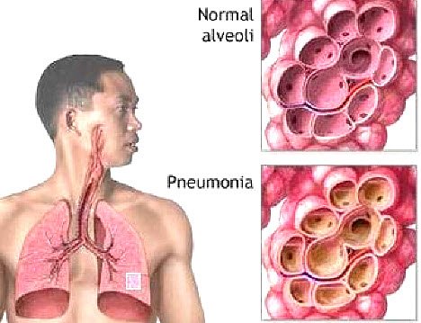 Пневмония на фото