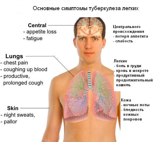Симптоматика туберкулеза