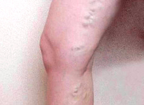 Симптомы атеросклероза ног