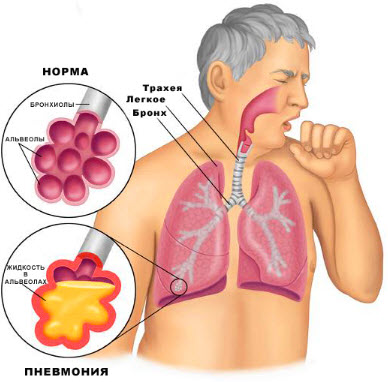 Пневмония - воспаление легких